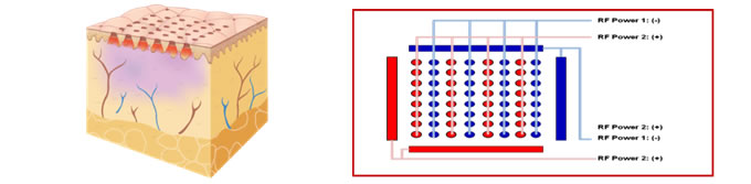 Fractional RF(ニードル無)