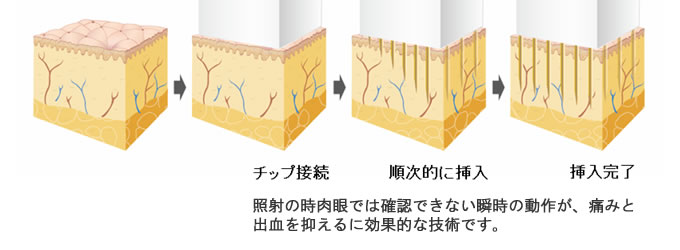 Flow-Needling Technology