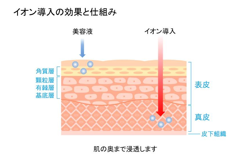 イオン導入